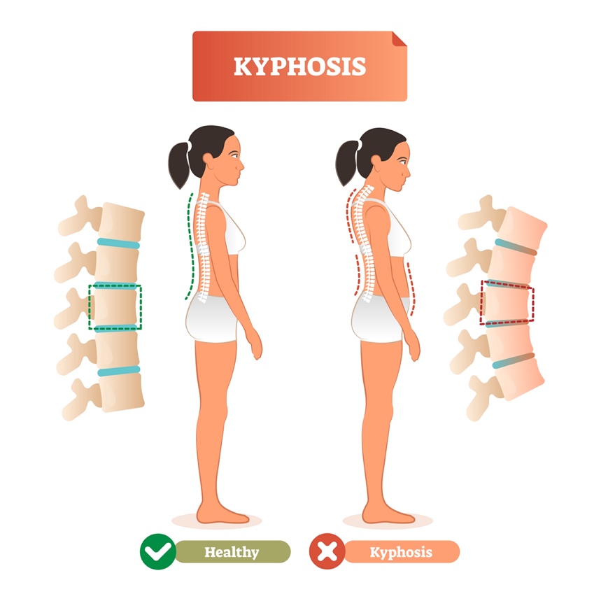 A diagram of Kyphosis