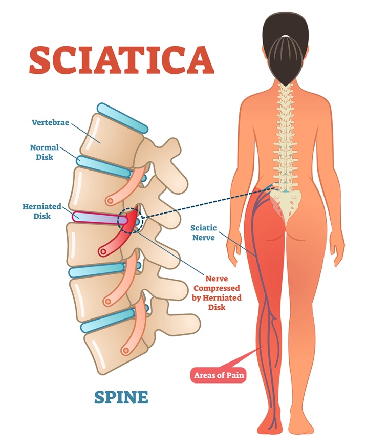 A diagram of sciatica