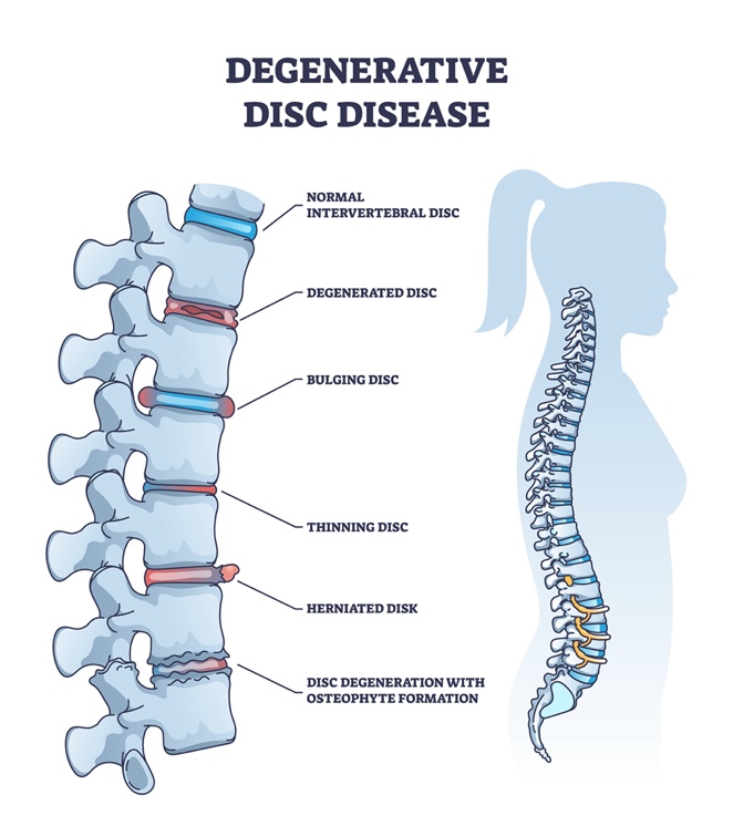 Degenerative Disc Disease