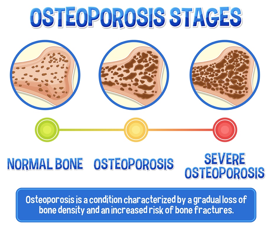 A diagram of Osteoporosis stages