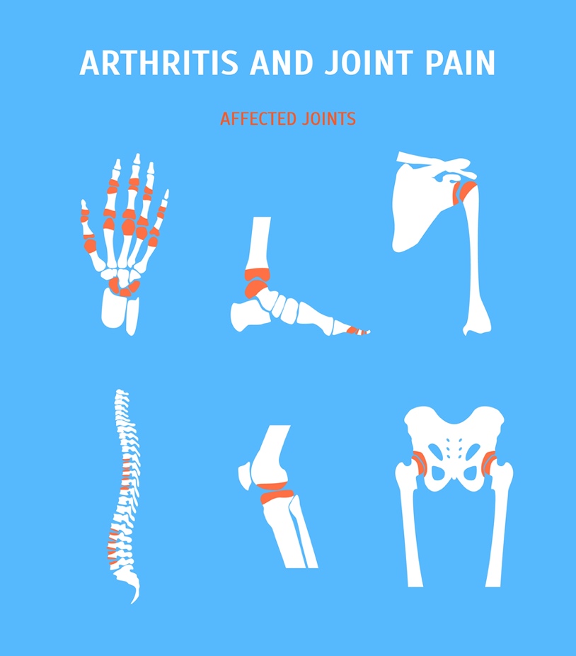 Arthritis and Joint Pain Affected Joints